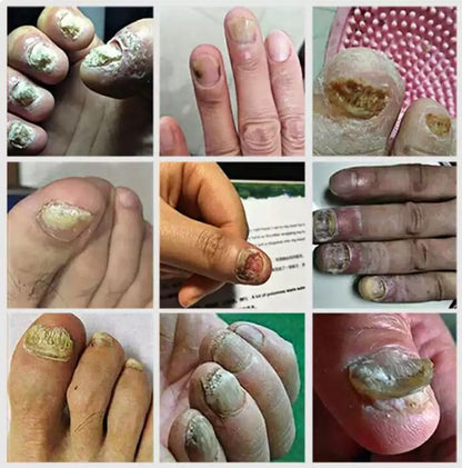 Ingrown Toenail Drops 60 ml Pack of 2